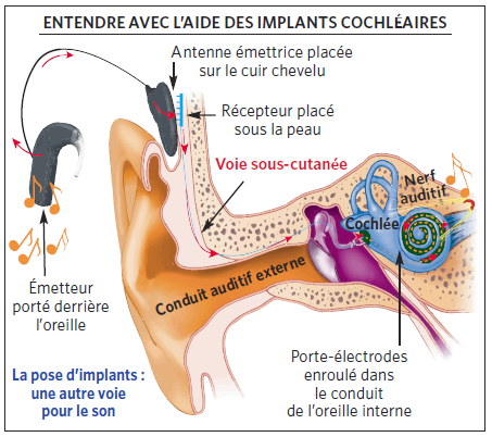 Implants cochleaires